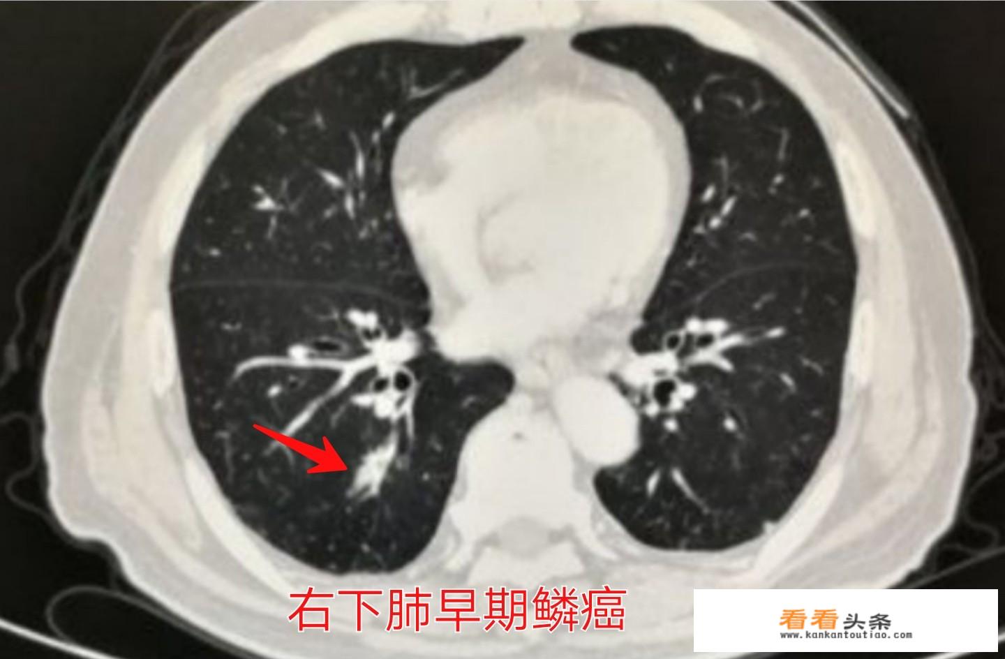 导致肺癌的因素有哪些？_张卫东上海交通大学