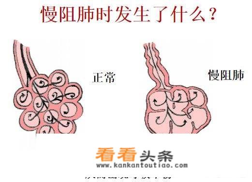 慢阻肺的高发人群有哪些？哪些诱因可以引发慢阻肺？如何预防？