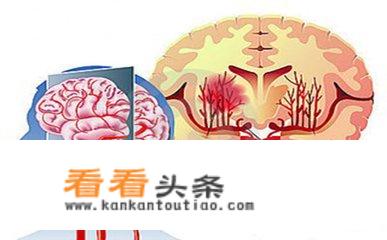 脑梗死患者需要注意哪些问题？