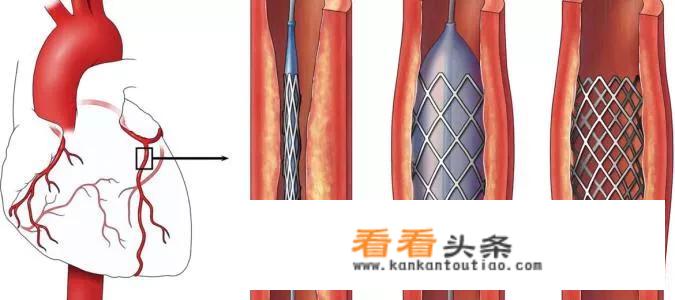 为什么有的血压不高的人会得冠心病？