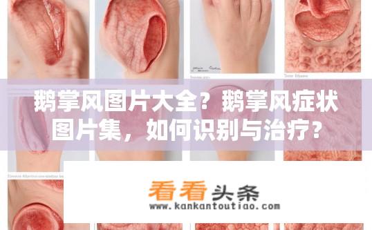 鹅掌风图片大全？鹅掌风症状图片集，如何识别与治疗？