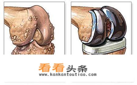 盐酸氨基葡萄糖和硫酸葡萄糖的区别？