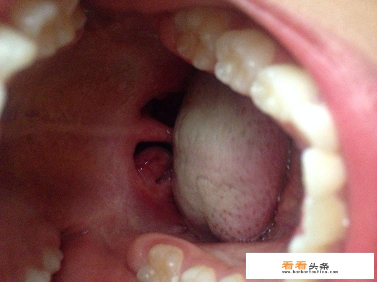 感冒发烧应该吃什么饭菜？