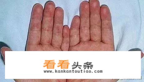 我是医院工作的，今天被艾滋病人抓伤了，请问被感染的几率大吗？