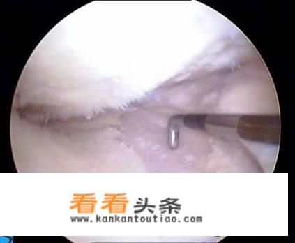 老伴膝关节内侧痛得厉害，坐着痛起床痛下蹲时痛，走路慢点不痛，是什么原因？