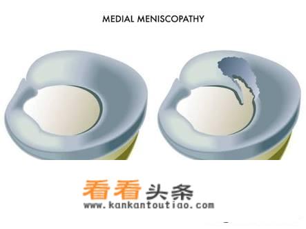 老伴膝关节内侧痛得厉害，坐着痛起床痛下蹲时痛，走路慢点不痛，是什么原因？