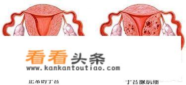 腺肌症痛经该怎么治疗