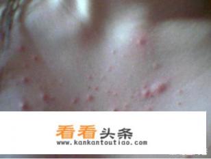 最近胸口突然间长痘，能抠但是又抠不出，一抠还很疼，到底是什么东西啊
