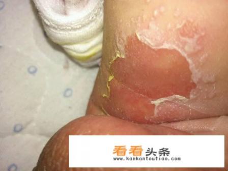 宝宝腋窝淹红了怎么办 宝宝腋窝淹红了怎么办
