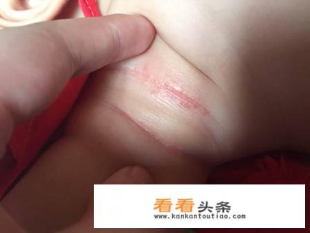 宝宝腋窝淹红了怎么办 宝宝腋窝淹红了怎么办