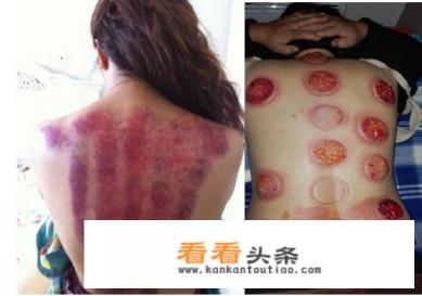 艾灸对子宫有什么好处？女性宫寒艾灸有效果吗