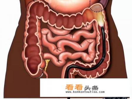 经常放屁是直肠癌的前兆吗 经常放屁是直肠癌的前兆吗